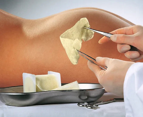 Opraclean® Mullbinde zur Tamponade mit Iodoform Lohmann & Rauscher