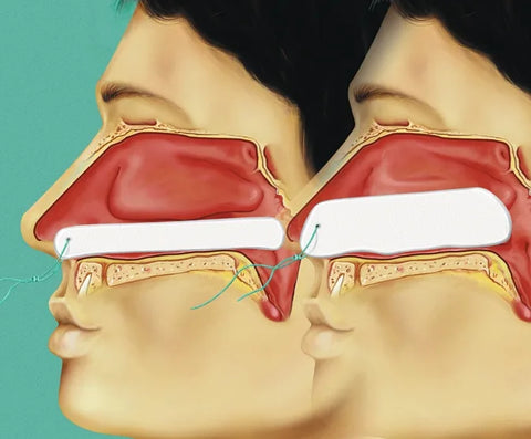 Raucocel Epistaxistamponade 3,8 x 12 mm, steril mit Faden mavivo