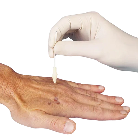 Ersatztips für Dermafreezer Set 50 Stück, 25 x Rundkopf + 25 x Spitzkopf servoprax