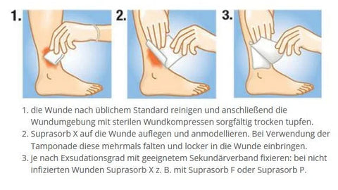 Suprasorb X HydroBalance Tamponade steril, 2x21cm, 5 Stück Lohmann & Rauscher