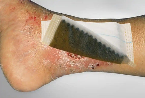 Vliwaktiv Ag Aktivkohle Tamponade mit Silber - steril Lohmann & Rauscher