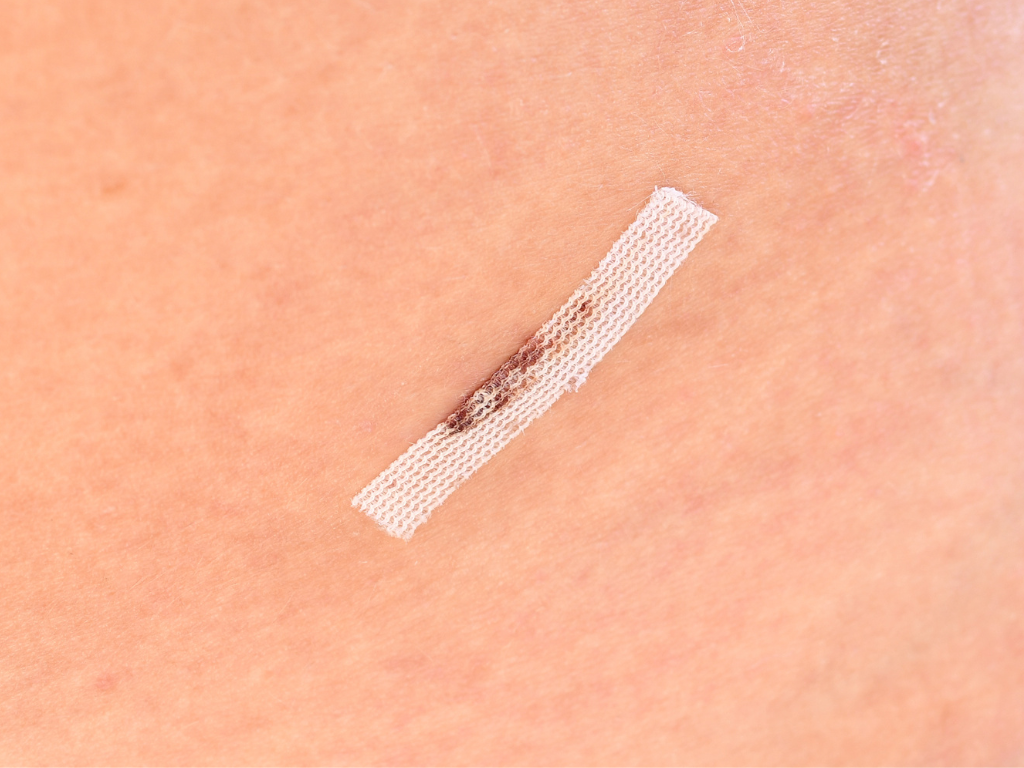 Wundnahtstreifen, Hautkleber & Klammerpflaster