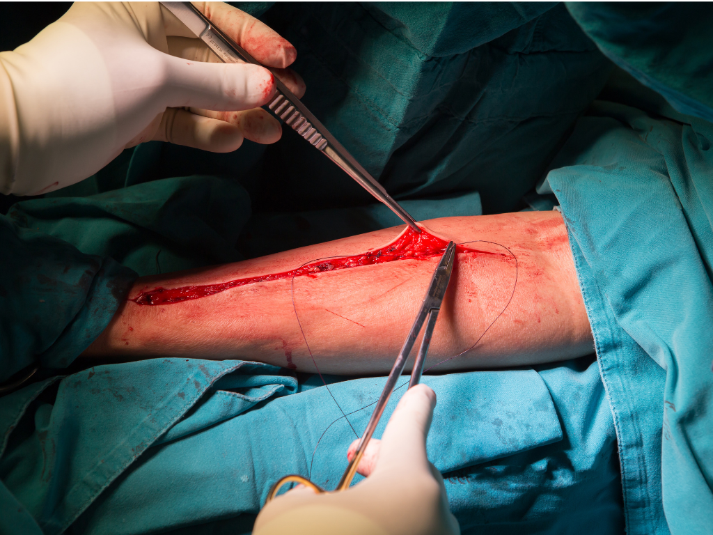 Chirurgische Wundnaht – unverzichtbar bei tiefen und klaffenden Wunden