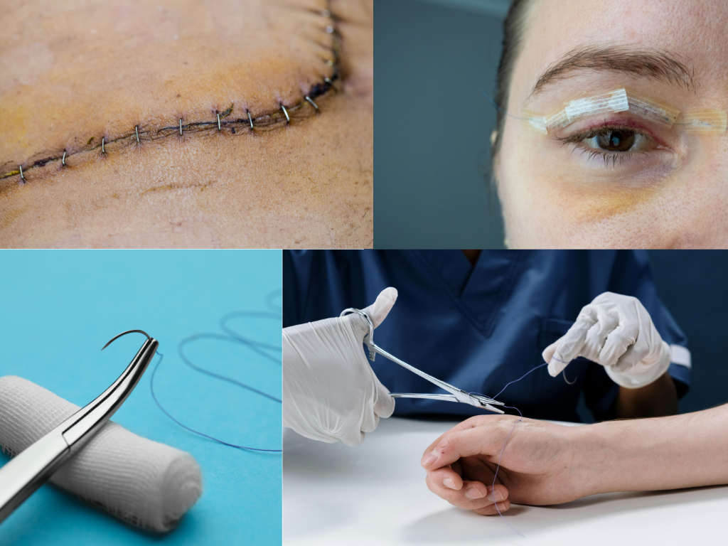 Wundverschluss – Moderne Lösungen für eine sichere und narbenarme Heilung